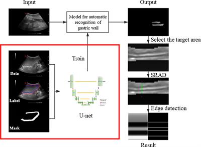 Automatic Detection of Gastric Wall Structure Based on Oral Contrast-Enhanced Ultrasound and Its Application on Tumor Screening